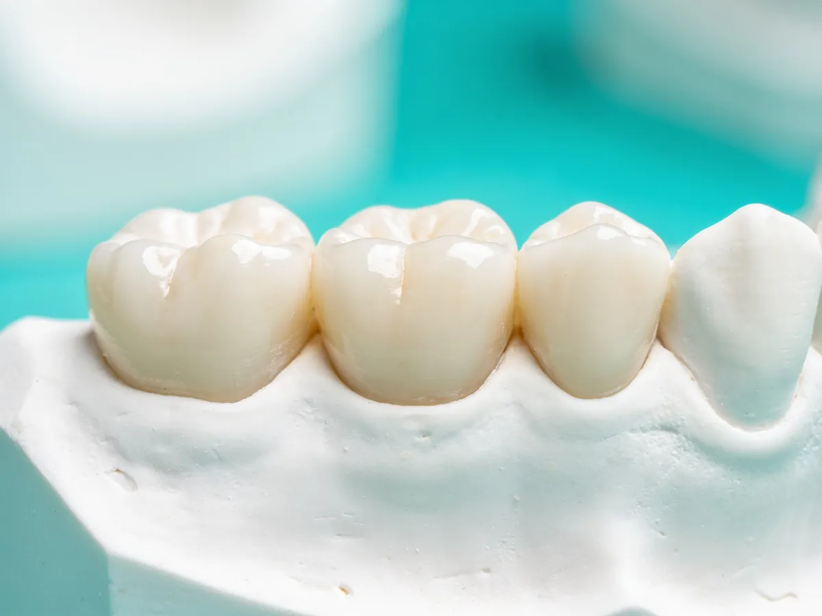 Dental Bridges