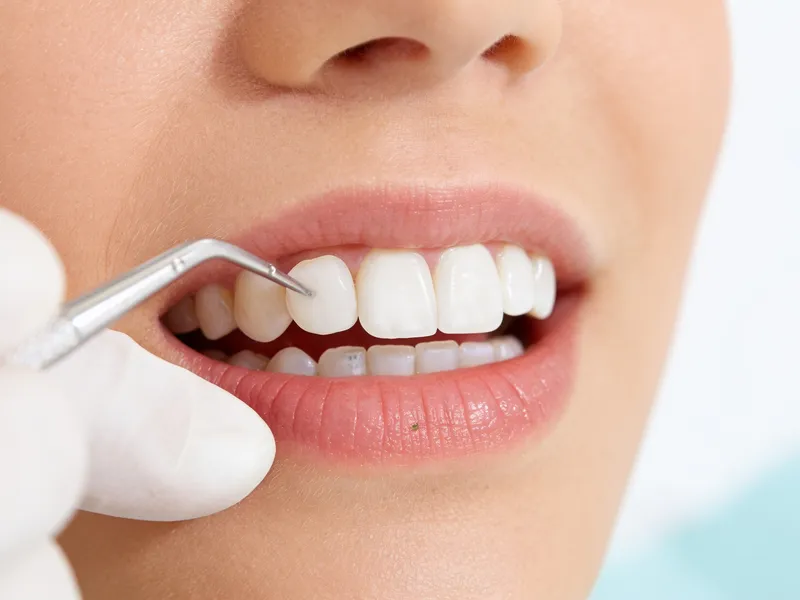 Veneers