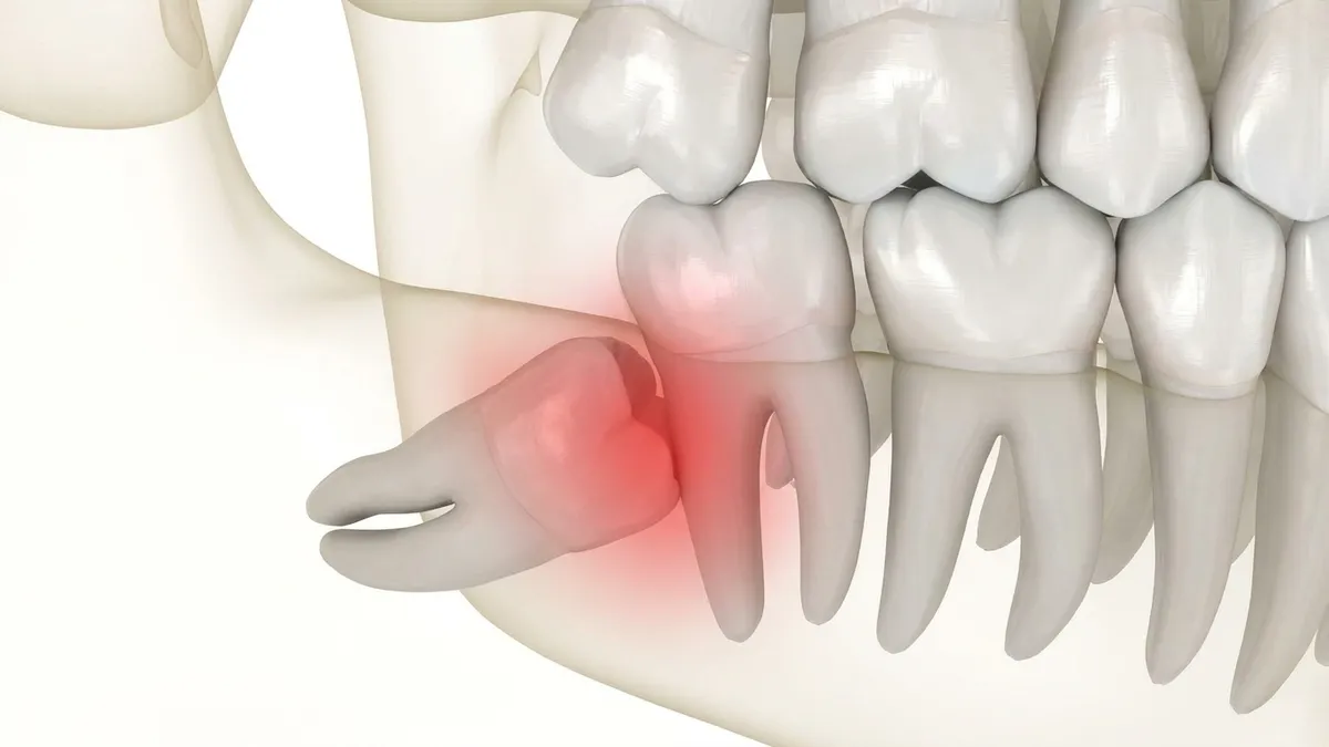 Illustration of an impacted lower wisdom tooth pressing against the neighbouring molar