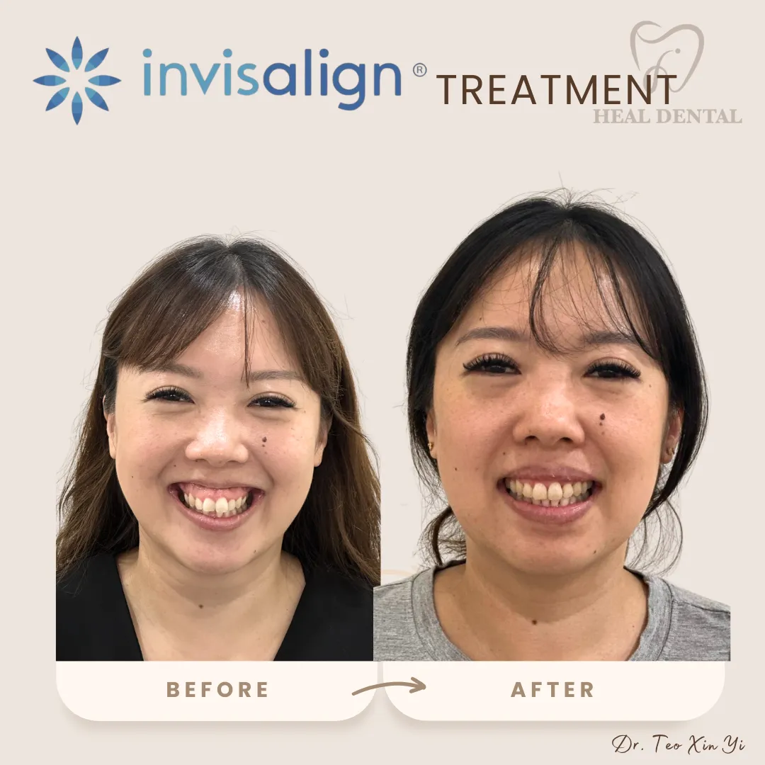 Invisalign before and after at Heal Dental Bukit Jalil, case 1