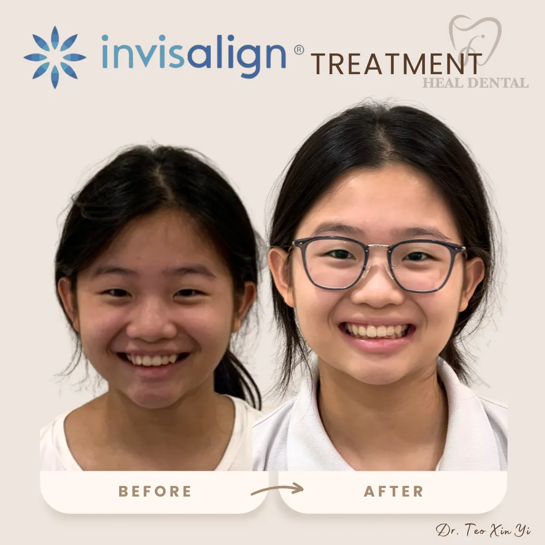 Invisalign before and after at Heal Dental Bukit Jalil, case 2
