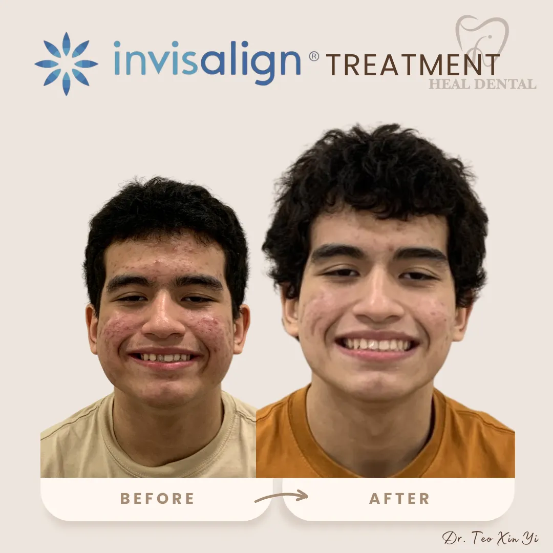 Invisalign before and after at Heal Dental Bukit Jalil, case 3