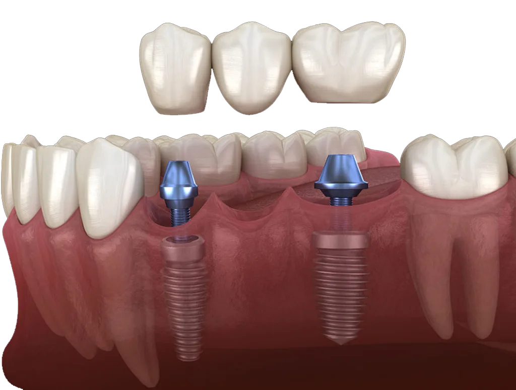 Implant supported bridge replacing several missing teeth